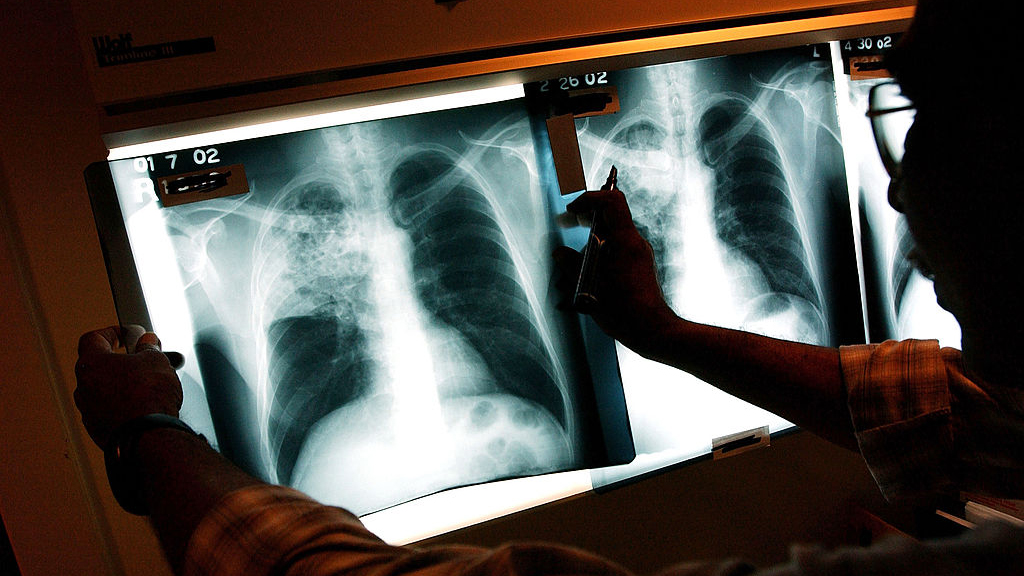 2 active tuberculosis cases traced to San Francisco strip club — KTVU FOX 2 Bay Area, Moraga Health news